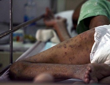 Aumentan los casos de sífilis