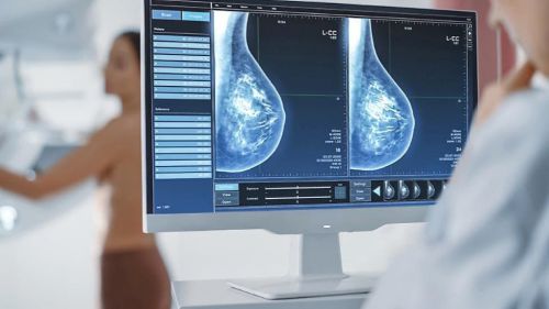 Prueban en Chile un algoritmo que permitiría predecir riesgo de cáncer de mamas a través de mamografías
