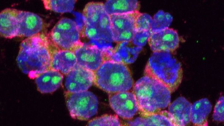 Células de linfoma difuso