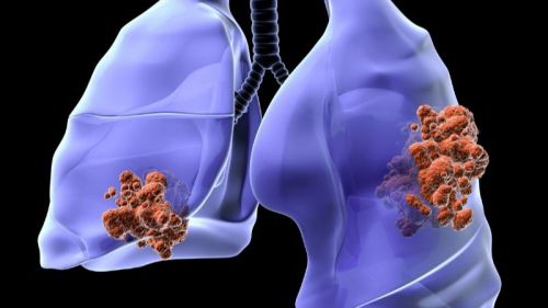 Estudios: Descubierta una de las causas de resistencia a la inmunoterapia del cáncer de pulmón más frecuente