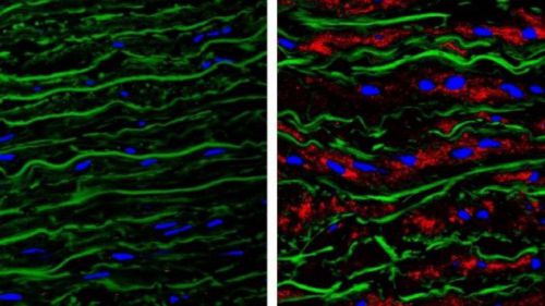 La acumulación de la proteína Versicano es responsable de los aneurismas de aorta del síndrome de Marfan