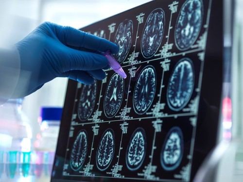 Investigadores del CSIC desarrollan una nueva escala de riesgo genético para el alzhéimer