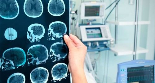 Cambios cerebrales en pacientes con Alzheimer y su impacto en la vida diaria