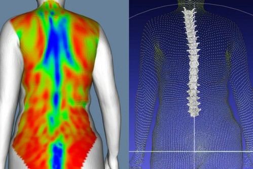 IBV desarrolla un escáner dinámico para estudiar deformidades de la columna vertebral