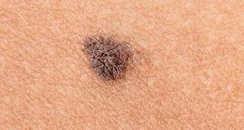 Investigadores de la ULE crean nueva inmunoterapia para melanoma agresivo
