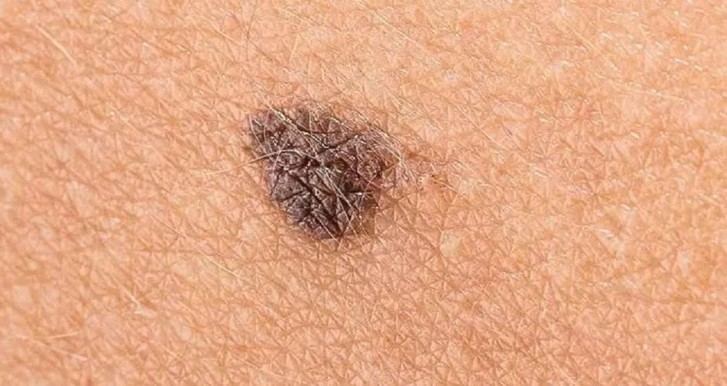Investigadores de la ULE crean nueva inmunoterapia para melanoma agresivo