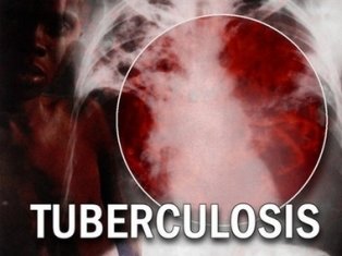Niños infradiagnosticados por tuberculosis